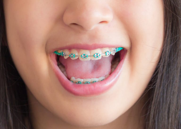 Kids getting braces in Singapore? Read this advice HoneyKids Asia